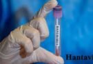 Hantavirus